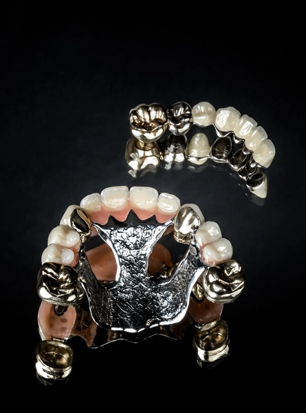 R&V Qualitätszahntechnik - Dentallabor - ein gegossenes Metallgerüst für eine herausnehmbare Teilprothese,