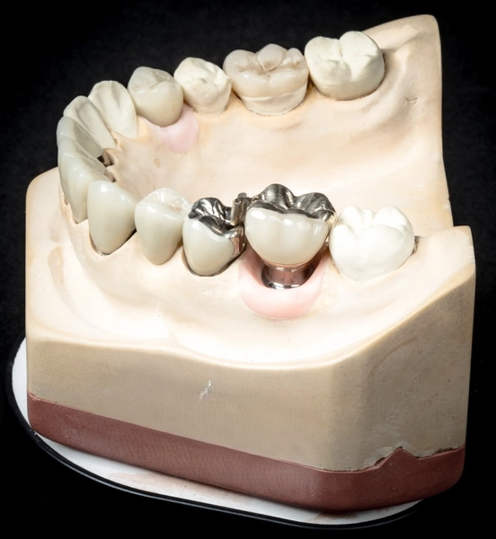 R&V Qualitätszahntechnik - Dentallabor - ein gegossenes Metallgerüst für eine herausnehmbare Teilprothese,