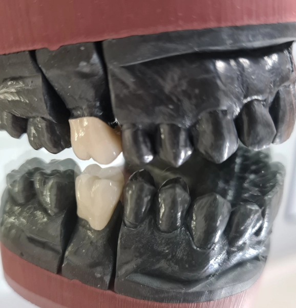 R&V Qualitätszahntechnik - Dentallabor - ein gegossenes Metallgerüst für eine herausnehmbare Teilprothese,